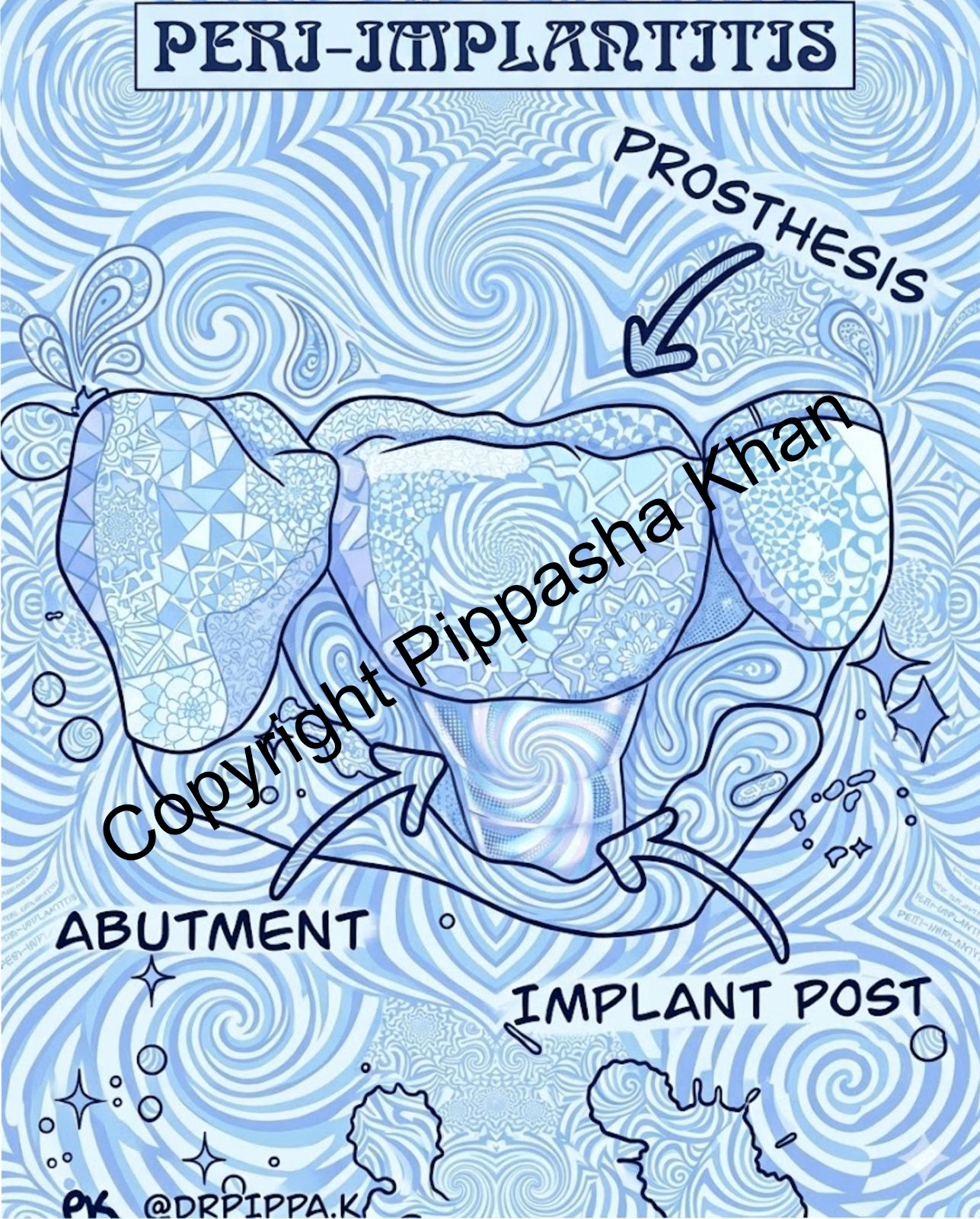 Peri-implantitis